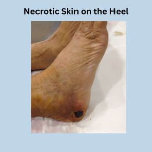 Heel gangrene
