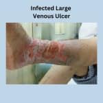Chronic venous insufficiency-Infected large venous ulcer