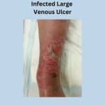 Chronic venous insufficiency-Infected large venous ulcer and surrounding skin cellulitis