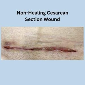 Non-healing cesarean section wound