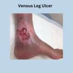 Venous leg ulcer