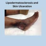 Chronic venous insufficiency- with lipodermatosclerosis and skin ulceration