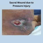 Sacral wound due to pressure injury