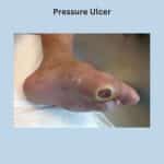 Diabetic foot ulcer