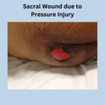 Sacral sore