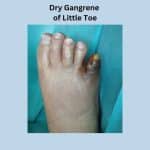 Right foot- dry gangrene of little due to poor blood supply