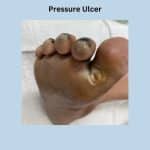 Diabetic foot ulcer
