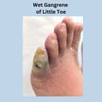 Left foot- wet gangrene of little toe due to poor blood circulation