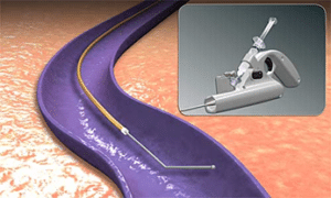 The ClariVein infusion catheter is inserted into the vein through the skin under ultrasound guidance.