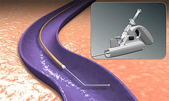 Title: Varicose Veins: The Treatment Options