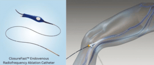 ClosureFast Radiofrequency probe Radiofrequency probe placed in a leg vein