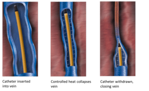 Steps on how vein is closed with radiofrequency ablation