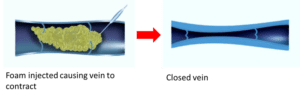 Foam sclerotherapy