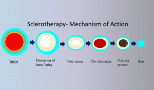 Sclerotherapy-Mechanism of action