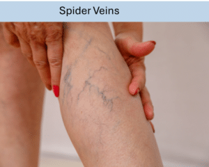 Spider veins in the leg