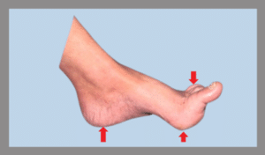 High-arch foot with pressure points