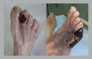 Diabetic foot gangrene
