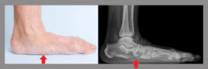 Flat foot with X-ray