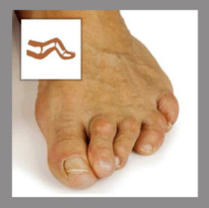Hammer toes