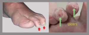 Claw toes with ulcers on the tips of toes