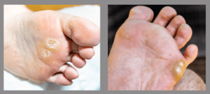 Diabetic foot- callus on pressure points
