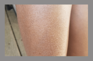 Diabetic autonomic neuropathy—dry skin