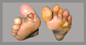 Diabetic Foot Ulcer
