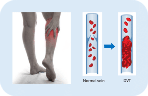 Deep Vein Thrombosis (DVT)- clot formation