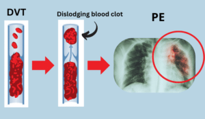 Pulmonary embolism (PE)