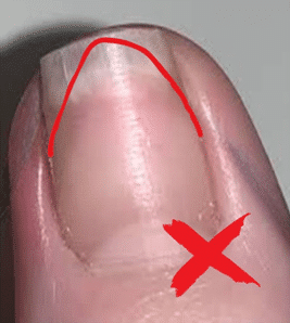 Nail trimming: V shaped trim