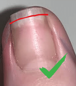 Nail trimming: cut straight across beyond the nail bed
