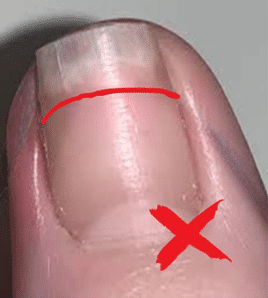Nail trimming: too short