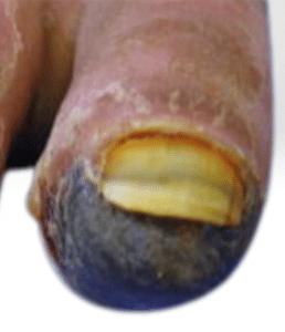 Big toe gangrene