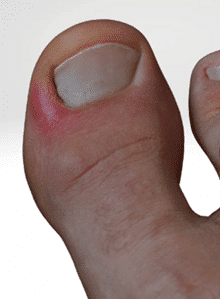 Ingrown big toenail with redness and swelling