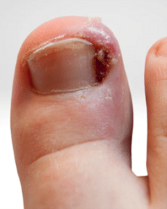 Ingrown big toenail with redness, swelling and discharge