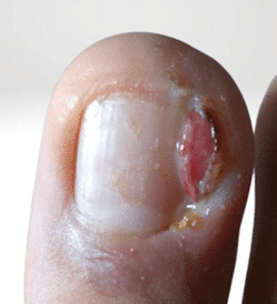 Ingrown big toenail with discharge and over granulation tissue