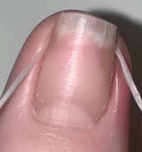 Elevation of ingrown nail edge with dental floss