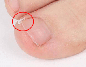 Elevation of ingrown nail edge with gutter splint