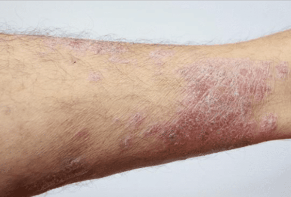 Chronic Venous Insufficiency - Vascular Clinic Singapore | Trusted ...