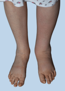 Lymphedema