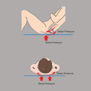 Bedsores ( Pressure sores) from Direct Pressure and Shear Pressure