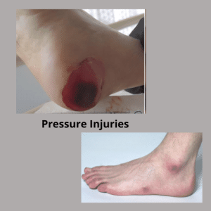 Pressure injuries ( pressure sores) to the foot