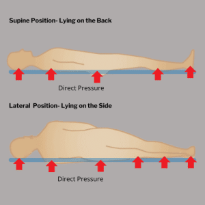 Pressure points in supine and side positions