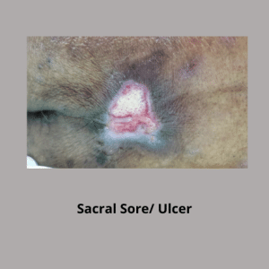 Sacral Ulcer / Sacral Sore