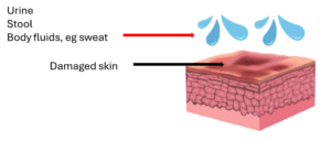Moisture-associated skin damage